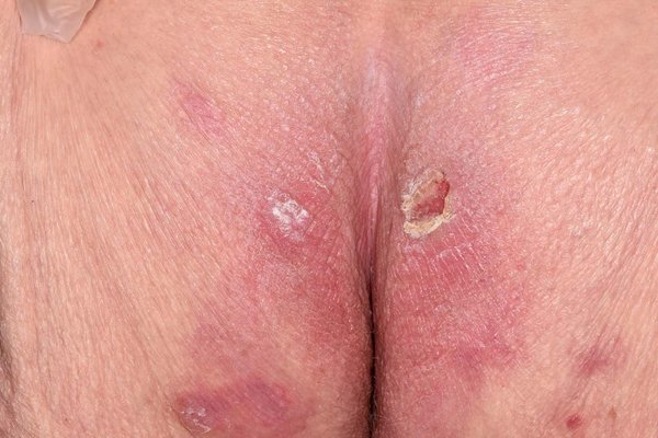 Managing Bed Sores